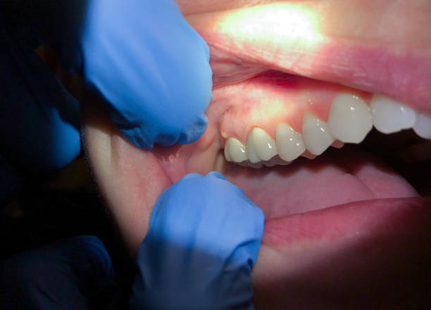 Best Emergency Dentist for Lost Fillings or Crowns in Lynden, WA